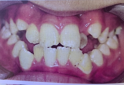 Thói quen thở bằng miệng và những ảnh hưởng đến sức khỏe